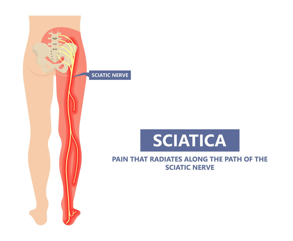 picture of sciatica