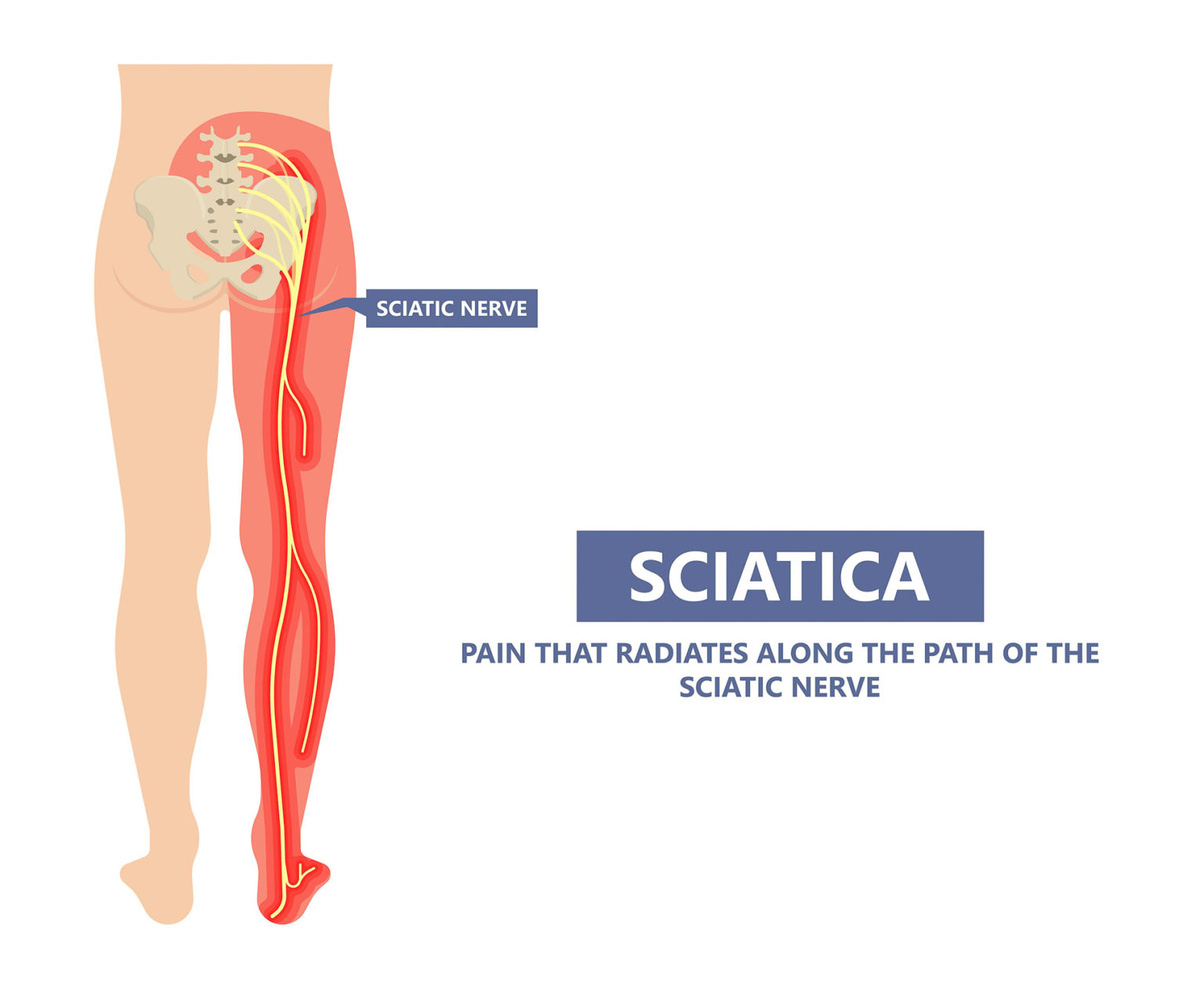 Pinched Nerve Relief. How to Know if it’s a Pinched Nerve North