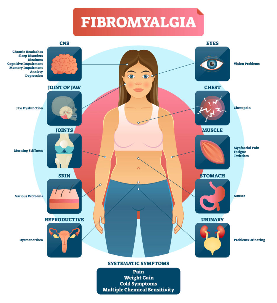 Fibromyalgia vector illustration. Diagnosis symptoms labeled diagram. Problems with jaw, joints, skin, muscle, eyes, urinary and reproductive system. Reason of fatigue.